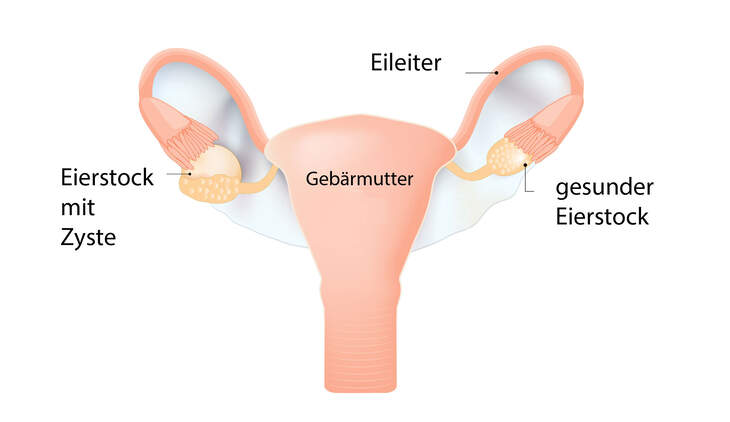 Geplatzte Zyste Am Eierstock Wie Lange Schmerzen Zyste am Eierstock: Das sollten Sie wissen! | Women's Health